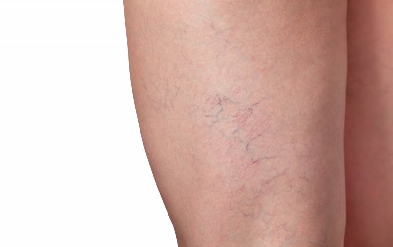 Le laser endoveineux , une alternative crédible pour les traitements des varices sans chirurgie à Martigues