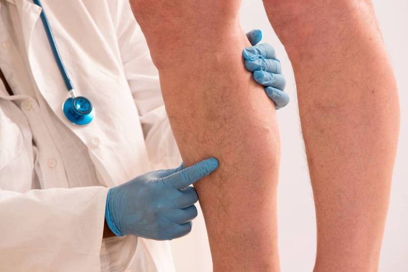 Traitement des Varices