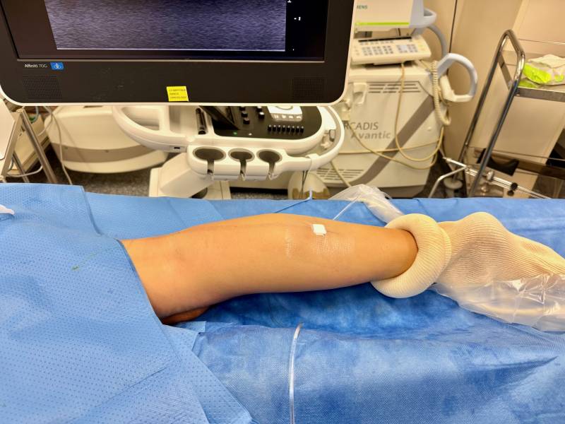 aspect de la jambe en fin de procédure . juste un petit pansement couvrant le point d'introduction de la fibre laser 