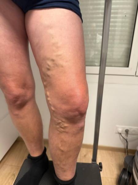 Traitez vos varices avec la sclérothérapie à Marseille