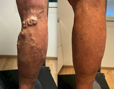 Notre zone d'activité pour ce service Traitement varice sans chirurgie avec laser endoveineux ou sclérothérapie mousse pour soins rapides efficaces et sans cicatrices