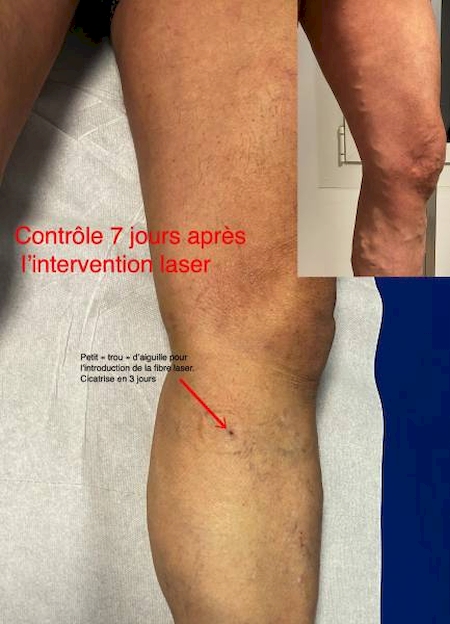Notre zone d'activité pour ce service Pourquoi vous avez des varices : votre docteur spécialisée varices Vitrolles PACA vous répond